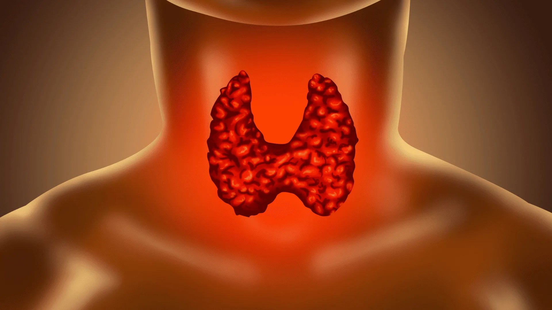 hypothyroidism